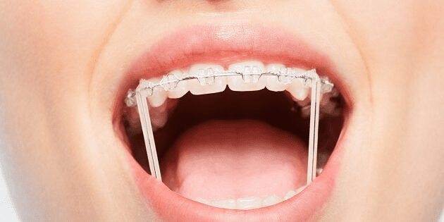 Invisalign With Rubber Bands: Benefits & Tips