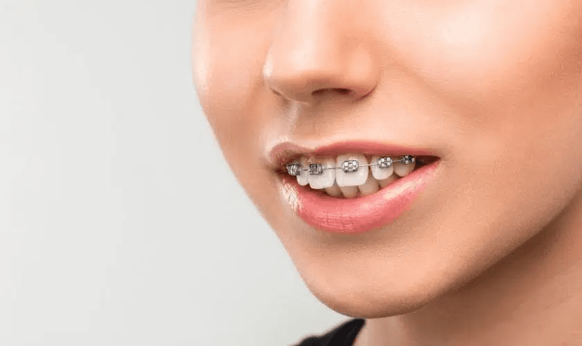 Can Invisalign Fix Overbites? What You Should Know